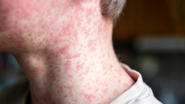 cbsn-fusion-the-measles-most-contagious-virus-known-humankind-doctor-says-thumbnail.jpg 